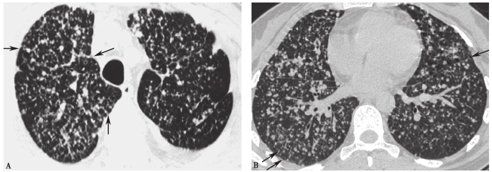 图5 乳腺癌肺内血行和淋巴道转移胸部CT表现.jpg